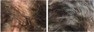 Traitement de la perte de cheveux (alopécie)