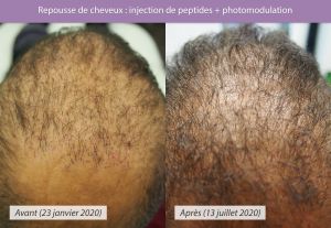 Résultat AV AP de repousse de cheveux au Centre anti-cellulite d'Avignon