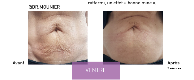 Radiofréquence Cristal Skin pour le visage, résultats avant/après, Avignon