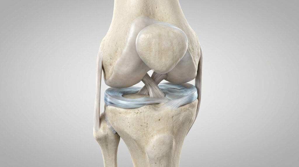 3D render of a human knee joint, showing femur, tibia, and a C-shaped medial meniscus with a horizontal tear.