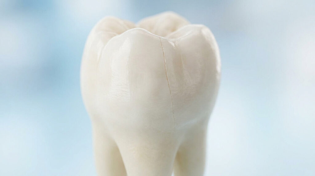 Gros plan d'une dent humaine avec une fissure verticale visible sur l'émail, sur fond bleu clair.