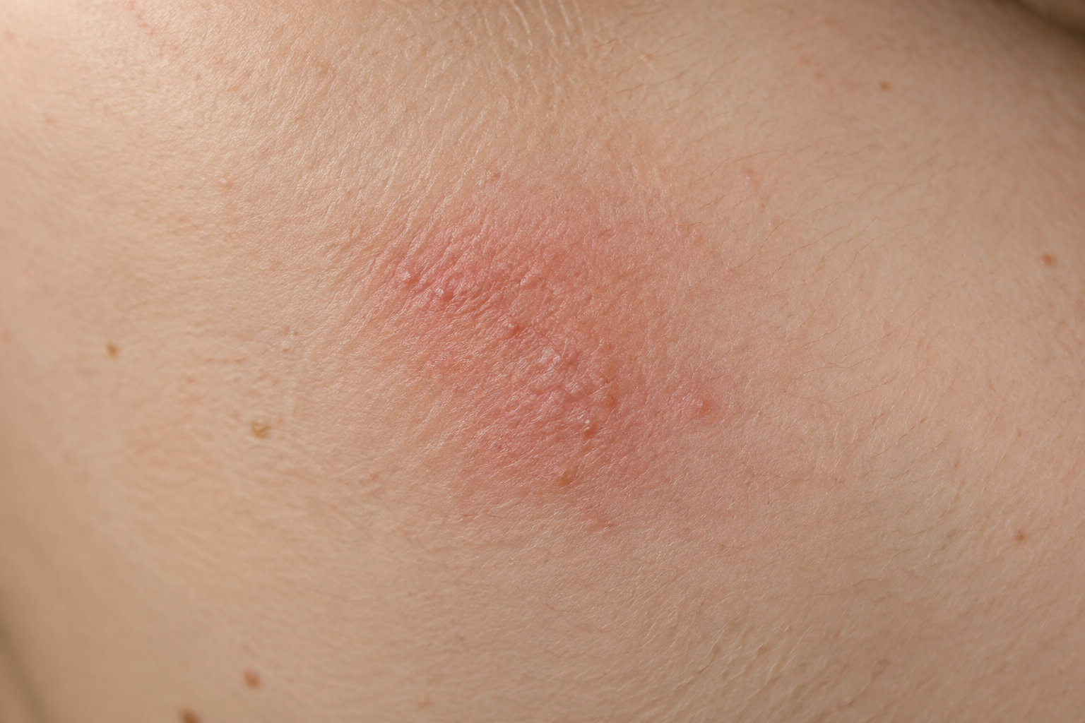 Gros plan sur une zone de peau présentant une plaque rouge et légèrement squameuse.