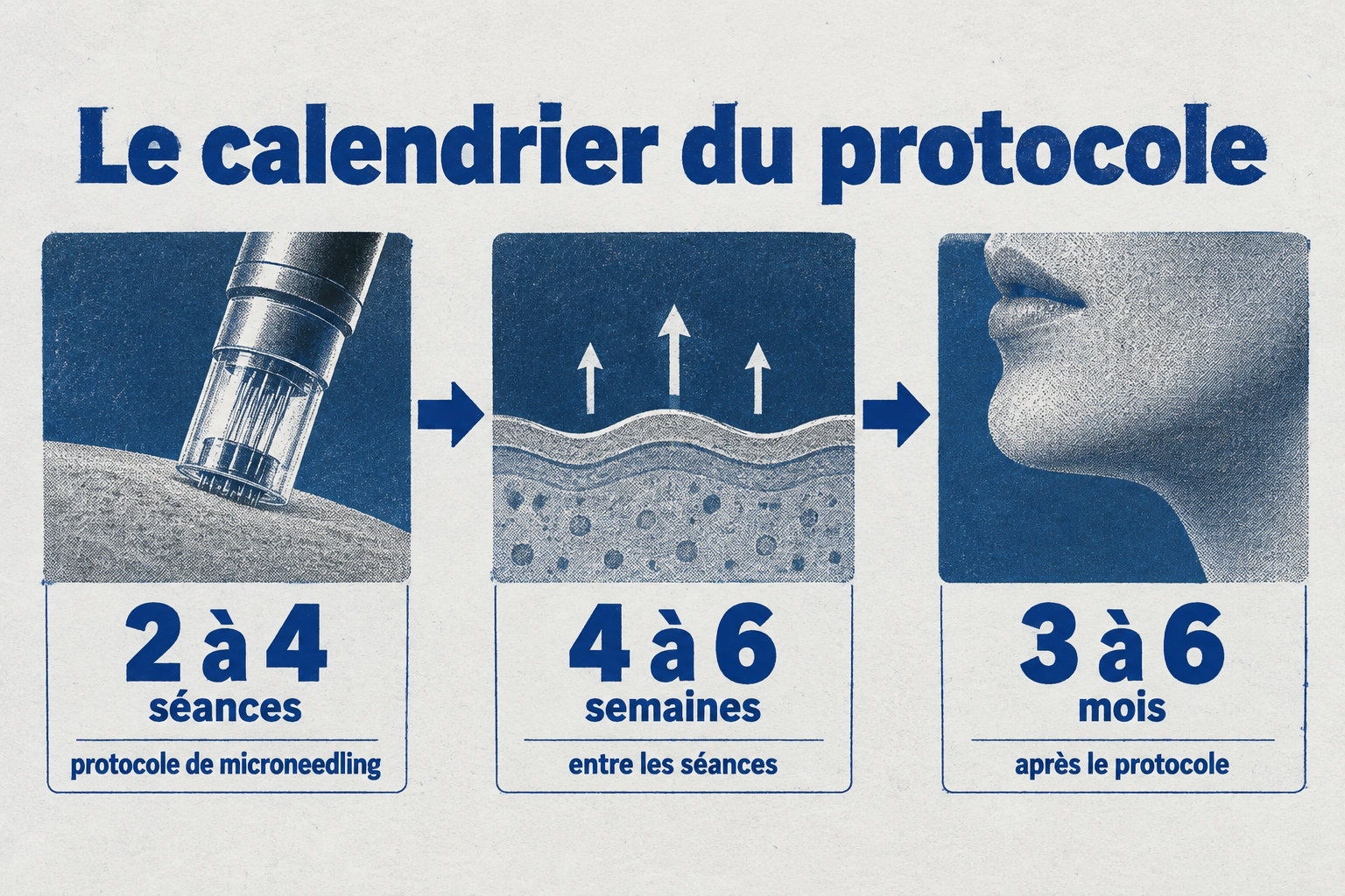 Le protocole de microneedling prévoit 2 à 4 séances espacées de 4 à 6 semaines, avec un résultat qui se précise entre 3 et 6 mois après le protocole.